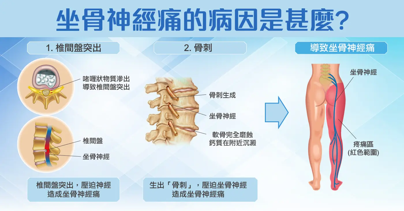 本頁圖片/檔案 - 坐骨神經痛成因