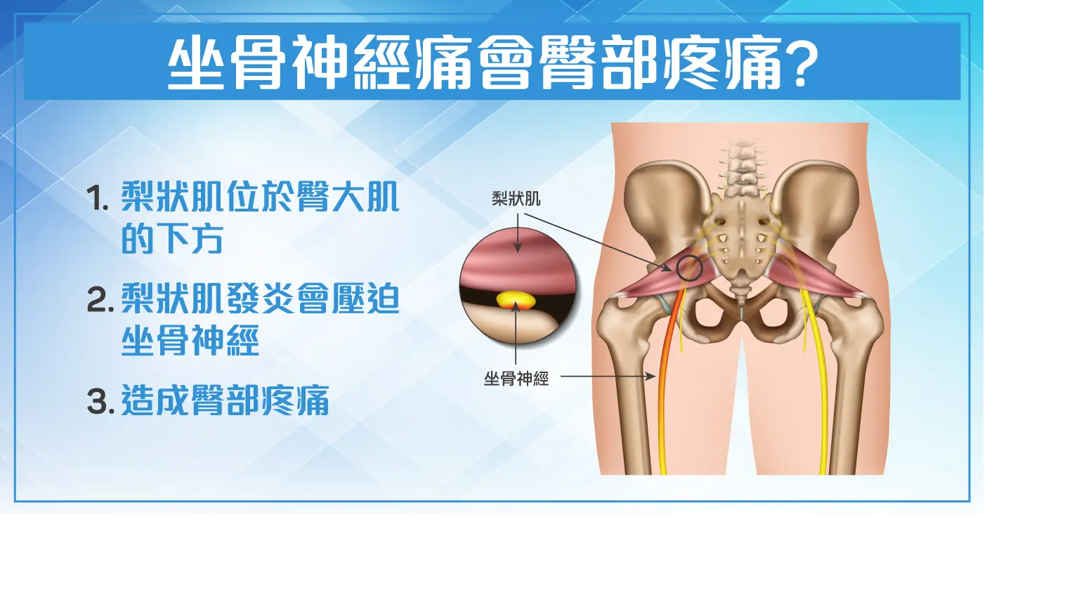 本頁圖片/檔案 - 梨狀肌發炎