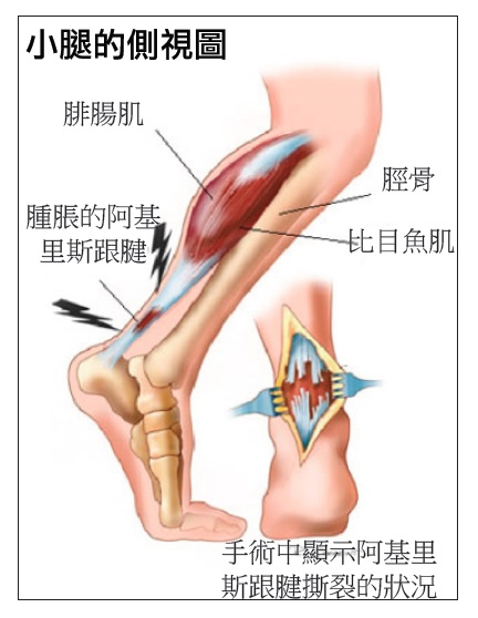 本頁圖片/檔案 - 破裂的阿基里斯跟腱