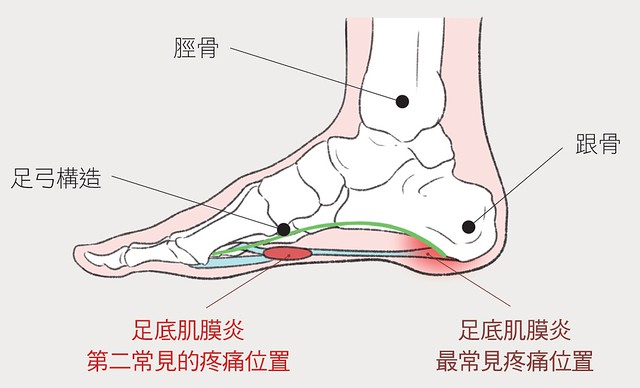 本頁圖片/檔案 - 足底筋膜炎