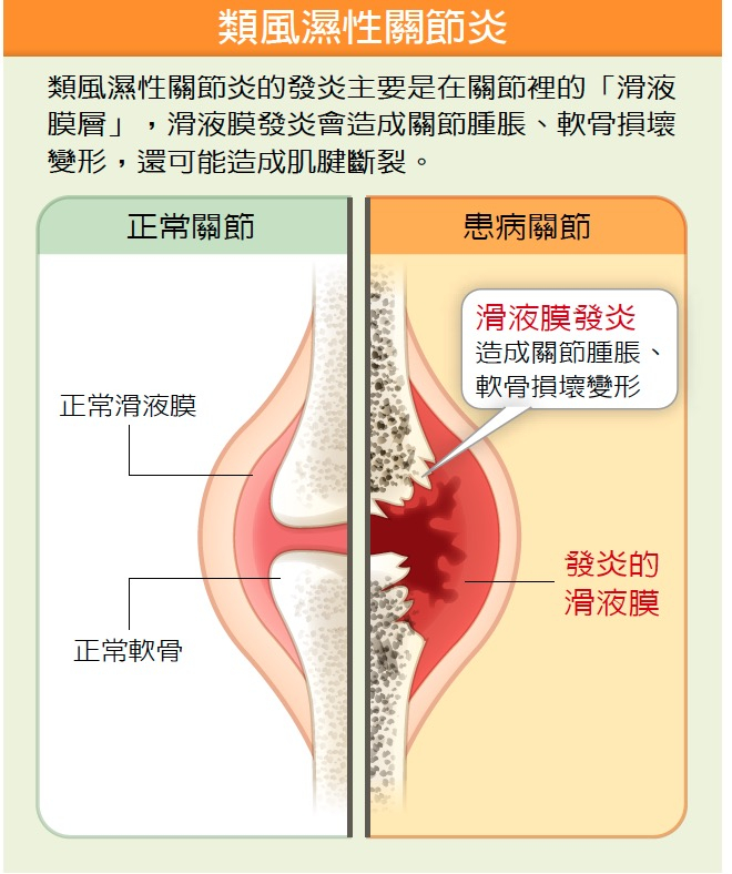 本頁圖片/檔案 - 類風濕性關節炎