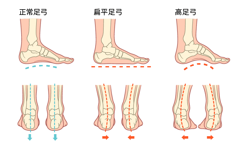 本頁圖片/檔案 - 扁平足