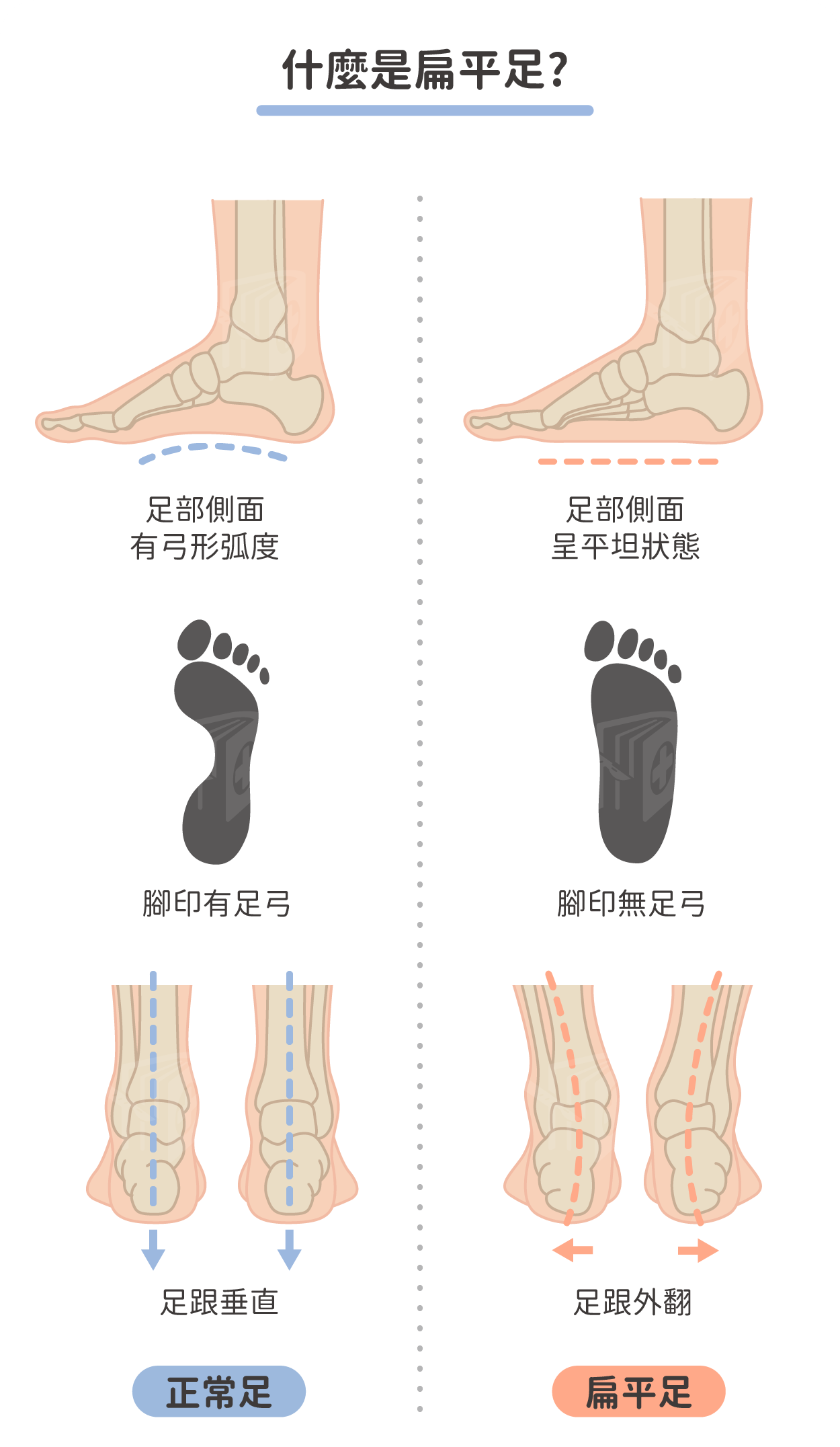 本頁圖片/檔案 - 扁平足的成因