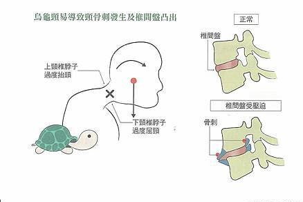 本頁圖片/檔案 - 烏龜頸