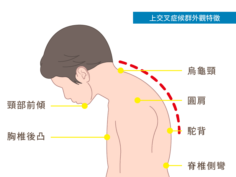 本頁圖片/檔案 - 駝背